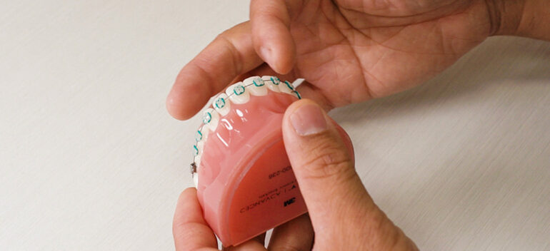 Orange Park FL Metal Braces Orthodontist