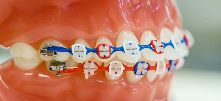 Ceramic Braces Orthodontist In Orange Park Fl