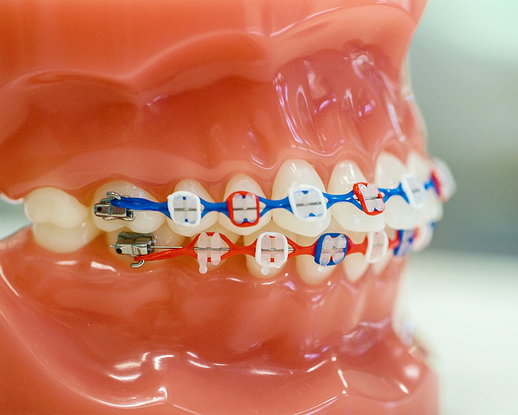 Ceramic Braces Orthodontist In Orange Park Fl